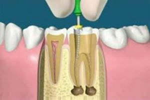 Endodoncija
