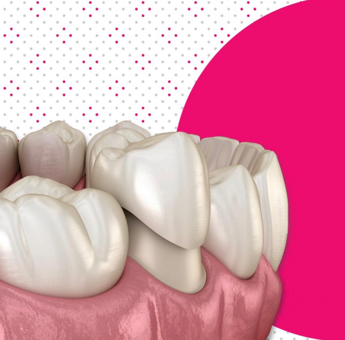 Učinkovita rje&scaron;enja za gubitak zuba