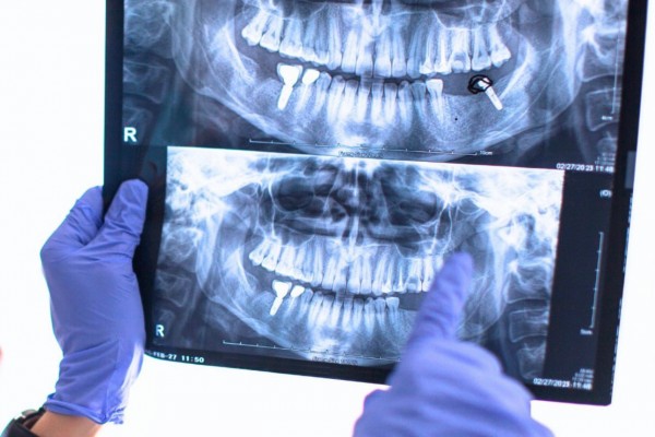 &Scaron;to otkriva CBCT snimka prije složenijih dentalnih zahvata