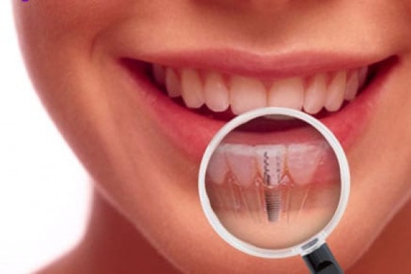 Zubni implantati – prednosti 